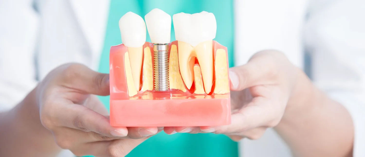 Provisional fixed teeth on the same day, when clinically suitable